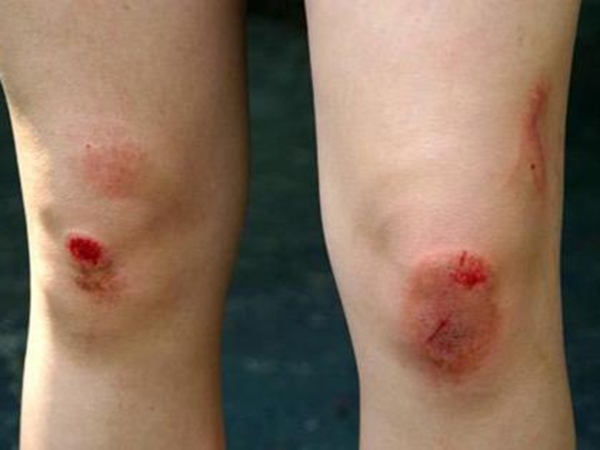 Nằm mơ thấy chảy máu chân có phải điềm gở?